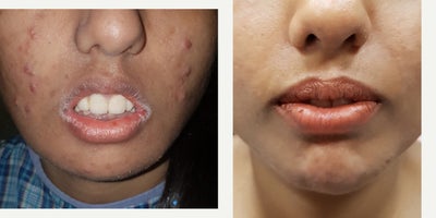25-34 year old woman treated with Botox for Gummy Smile - 26 year old who had oral incompetence treated with botulinum toxin and had acne treatment