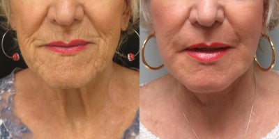 65-74 year old woman treated with Dermabrasion - This patient underwent dermabrasion to her peri-oral area during her facelift along with fat transfers to multiple areas of the face