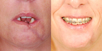 Scar Revision - Lower Lip - 
	Before and after scar revision of lower lip. The entire lower lip was taken apart and reconstructed to repair mucosa (lip lining), put muscle back together and improve the external scar. A single procedure was performed.
