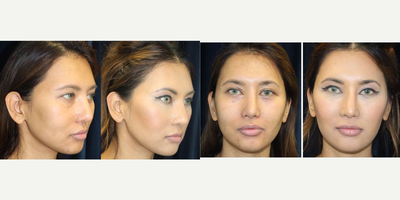 35-44 year old woman treated with Non Surgical Face Lift - Before and Afters&nbsp;