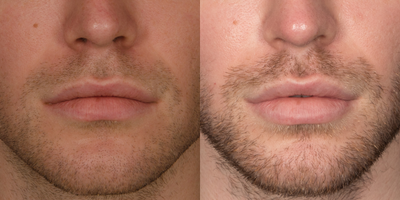 25-34 year old man treated with Lip Augmentation - Before and After of male lip injections using Revanesse Versa