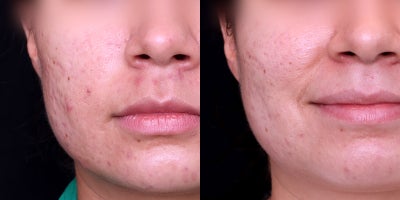 25-34 year old Female underwent Acne treatment - This patient presented for acne treatment. Following a series of photo dynamic therapy treatments, once active acne was the patient was treated with a series of fraxel 1550nm laser treatments to improve acne scars.