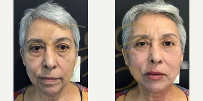 Woman treated with Liquid Facelift - Woman treated with Liquid Facelift