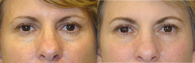 Active FX Laser Resurfacing - Active & Deep FX Laser Resurfacing was performed. Notice the general improvement in tone and texture of the skin, and improvement of the wrinkles and pores.