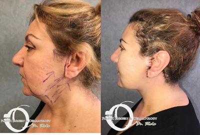 35-44 year old woman treated with Eyelid Surgery - 5 days after advanced Mehr design face and neck lift as well as upper eyelid surgery