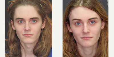 18-24 year old Transgender woman treated with Facial Feminization Surgery - This patient wanted subtle improvements and underwent phase 1 facial feminization surgery. Her primary concerns were her hairline, brow position, and adam's apple. She underwent Trichophytic Brow Lift, with glabella reduction and hairline advancement, tracheal shave, and osteoplasty of the jaw to narrow the chin and remove the cleft.