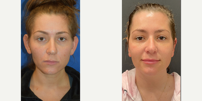 35-44 year old woman treated with Ear Surgery - Before and After: Otoplasty