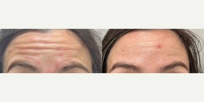 35-44 year old woman treated with Botox for Migraines - Treated by Aubrey Houchin