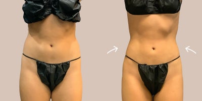 25-34 year old woman treated with AirSculpt - Patient recevied Stomach AirSculpt. AirSculpt is not only focused on removing as much as possible. Sometimes true body contouring is knowing that only a little amount of adjusting can make a world of a difference depending on the body type. Patient have fat removed from her stomach region and is 3 months post-op. Procedure was done in our Orlando location.