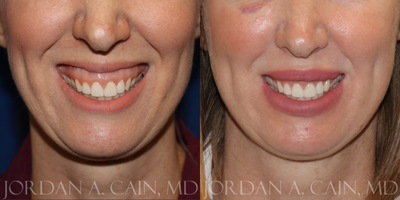 35-44 year old woman treated with Botox for Gummy Smile - 35-44 year old woman treated with Botox for Gummy Smile - 2 weeks post-op