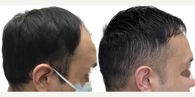 29 year old man treated with FUE Hair Transplant, Minoxidil and Finasteride - This is a gentleman who came to us at only age 29 for a hair transplant. His hair loss began in his early 20s and in only a few short years progressed to at least a Norwood Stage 5, or maybe beyond. He had never tried any evidence-based treatments to slow or reverse his hair loss. Despite his young age, he had complete obliteration of his hairline and front scalp, with near complete loss in the midscalp through to the crown. The result was disproportionate features, the loss of the frame to his face, and the appearance of being much older than his 29 years. Fortunately, he had an excellent donor area. Prior to surgery, we discussed the importance of supplementary non-surgical therapies like finasteride and minoxidil to help him preserve the hair he still had. In this way, we could use a hair transplant to replace what hes lost, knowing that hed be highly unlikely to lose additional hair in other areas. As a result of his large and dense donor area, we were able to perform a 3146 graft FUE surgery. This is one of the largest single session FUE surgeries ever performed at Toronto Hair Transplant Centre and is a larger graft amount for this type of surgery than average. You can see from our surgical drawings that his goal was not to achieve an overly aggressive hairline, but rather to have a natural hairline that preserved enough donor grafts to add some density in the midscalp and crown, while still giving him a frame to his face and good coverage upfront. He wanted the kind of hairline that would continue to look natural into his 30s, 40s, 50s and beyond. The majority of the grafts were distributed to the frontal scalp to rebuild the density there, while a few were added to the midscalp and crown. We knew this would not add overly thick density to those areas, but it would still make a significant difference. This patient returned to see us 13 months after his surgery. His results are absolutely amazing! He looks like, well, just a guy with hair! His forehead is much less prominent and he looks much more youthful and in line with his age. You can see in the detailed photo of his hairline that it looks completely natural and no one could ever tell hes had a hair transplant. His donor area continues to look dense without any noticeable evidence of even a large FUE harvest. He continues to use finasteride and minoxidil regularly, without any problems, and hasnt lost any additional hair. He looks great!