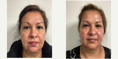 35-44 year old woman treated with Dermal Fillers, Cheek Fillers, Chin Filler, RHA Collection Fillers, Liquid Facelift - patient had wanted a refresh look and something that would make her face look slimmer so we injected lateral cheek, did chin, mandible, marrionette, nasiolabial fold
