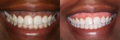 Gum Lightening - We can remove pigmentation from the gums.  Totally painless and takes less than 30 minutes.
