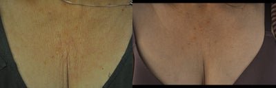 59 Year Old Woman Treated for Laxity on Chest - Exillis Elite (1 treatment) on chest to address skin laxity and wrinkling on chest.