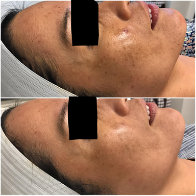 Middle aged woman's melasma bettered by just 1 superficial PCA Peel - This woman had tried everything to help her melasma. We did a PCA Peel on her and 4 weeks later she was so impressed and said this was the treatment that is going to work for her.Pictures show one treatment results, client will be doing a series of 2 more. Her skin already looks so much healthier.