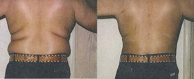Liposuction of Upper Back - Male shown before and after tumescent liposuction of upper back.