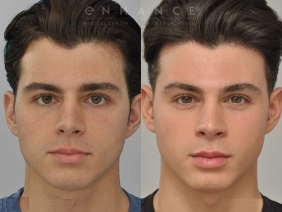 Man treated with Cheekbone Reduction - The upper face was narrowed with cheekbone shaving, performed mainly from inside the mouth.