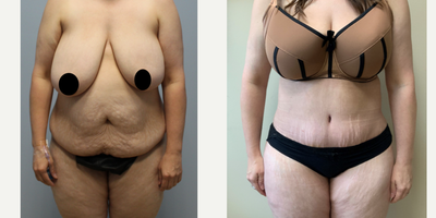 35-44 year old woman treated with Vaser Liposuction - Patient underwent 360 lipo and a tummy tuck