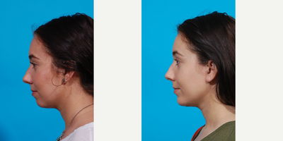 18-24 year old woman treated with Chin Implant - Young woman who consulted with Dr. Jerold Olson with requests to improve the chin area. Dr. Olson recommended she have a chin implant surgically placed to provide depth. She is pleased with her results.