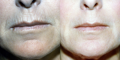 55-64 year old woman treated with Dermabrasion - 56-year-old before and four months after dermabrasion of lips and chin.