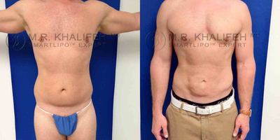 35-44 year old man treated with Smart Lipo - Male lipo contouring awake, via smartlipo, shown at 1 months only (some residual swelling still visible).