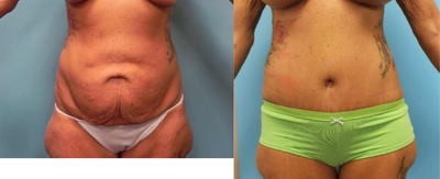 45-54 year old woman treated with Slim Lipo - Slim Lipo with Abdominoplasty and Breast Augmentation