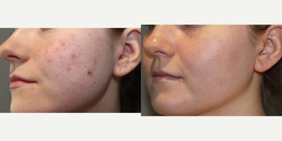 25-34 year old woman treated with PRP Injections, Vampire Facial - 13130: vampire facial25 yo, F, 55, 127lbs, G0P0