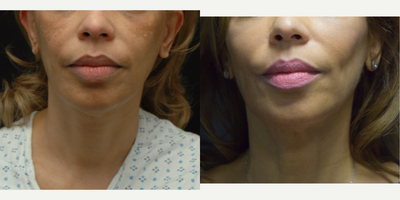 55-64 year old woman treated with Ultherapy - 55-64 year old woman treated with Ultherapy on the lower face and neck