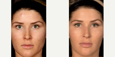 COMBATING CYSTIC ACNE - Our lovely patient has been constantly struggling with severe cystic acne. Wanting to gain her confidence back, she came to us. To tackle her acne, we did a combination treatment of Isotretinoin, an oral medication, as well as laser treatments using both the aerolase and clear and brilliant lasers. We were able to get her skin smooth and glowing; she absolutely loves her skin now and has gotten her self esteem back!WHAT IS AEROLASE?@aerolase - a microsecond laser that tightens skin, and deeply heats the dermis to stimulate collagen and blend the complexion to be more even toned without any downtime.Clear and Brilliant Touch is a low downtime laser that uses dual wavelengths to improve various depths of the skin including the collagen producing deeper layers and the upper portions of the skin that need cell turn over for improved texture and tone. Low density lasers are safe for all skin types with a lower risk of hyperpigmentation, and should be combined with microneedling or microneedling RF to enhance the improvement in fine lines and scars.WANT THIS TREATMENT? CONSULT WITH US: 