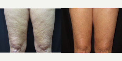 45-54 year old woman treated with Cellulaze - Before and after Cellulaze