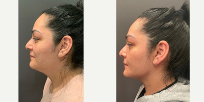 25-34 year old woman treated with Neck Liposuction - Before and After: Neck Liposuction performed by Dr. Almonte