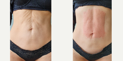 35-44 year old woman treated with Microneedling RF - 34-year-old patient with loose skin after Liposuction, who went for a Skin Tightening procedure, fixer which is a Microneedle RF of the last generation was performed.