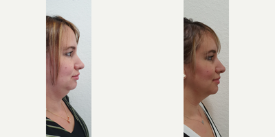 35-44 year old woman treated with Kybella - Patients who underwent 3 sessions of non surgical chin treatment with kybella