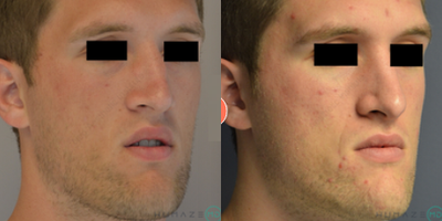 Man treated with Rhinoplasty - Man treated with Rhinoplasty