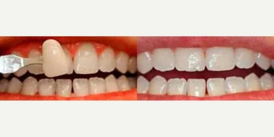 Woman treated with Teeth Whitening - Woman treated with Teeth Whitening