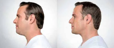 Man treated with Kybella - Man treated with Kybella to chin area, shown before and after 3 treatments.