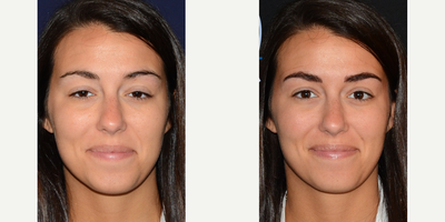 25-34 year old woman treated with Microblading - Microblading treatment of the eyebrows.