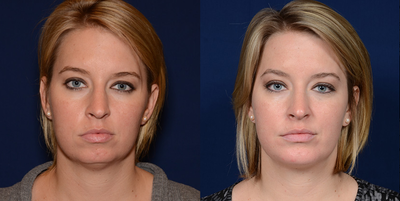 Chin Augmentation - Chin Augmentation