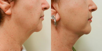 55-64 year old woman treated with Chin and Face Liposuction, with Neck Lift with Platysmaplasty. - 55-64 year old woman treated with Chin and Face Liposuction, with Neck Lift with Platysmaplasty.
