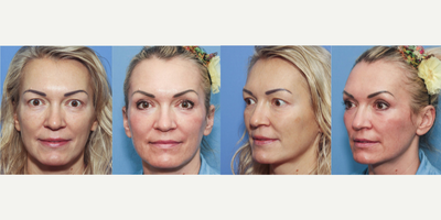 49 year old woman treated with Laser Peel - Contour TRL treatment for correction of fine lines and skin discoloration.  Note tightening of upper and lower eyelids, this was just using the laser, no surgery was performed.