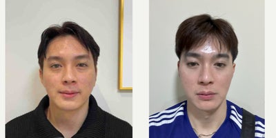 35-44 year old man treated with Cheek Implants, Facial Fat Transfer - .