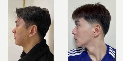 35-44 year old man treated with Cheek Implants, Facial Fat Transfer - .
