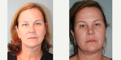 62 year old woman treated with Lifestyle Lift - The doctor performed his exclusive LiteLift modififed facelift which is lighter on incisions, anesthesia (local was used) and recovery. He also performed neck lipo to reduce fullness followed by a platysmaplasty to reduce visibility of neck banding. After surgery, notice the improvement in her lower neck area. After photos were taken 2 years post-op.