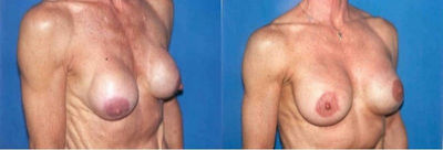 Woman treated with Breast Implant Revision - Woman treated with Breast Implant Revision