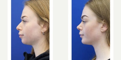 25-34 year old woman treated with Rhinoplasty, Chin Implant - A slight slope to the nasal profile in combination with balanced chin projection results in a harmonious facial appearance. An elegant nasal and chin profile is exactly what the doctor ordered.