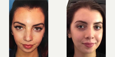 Woman treated with Restylane Silk - Woman treated with Restylane Silk for fuller upper lip and to give her face and mouth more balance