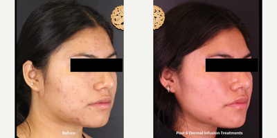 18-24 year old woman treated with Dermalinfusion - Dermal Infusion - Before & After