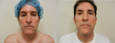 Man treated with Facial Fat Transfer - Man treated with Facial Fat Transfer to the eyes and Neck Lift.