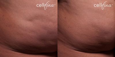 45-54 year old woman treated with Cellfina - 46-year-old female patient treated for cellulite on buttocks.