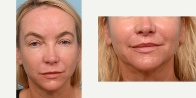 35-44 year old woman treated with Lip Lift - The doctor preformed a Surgical Lip Lift to shorten the distance of a long upper lip and elevate her upper lip only 4 months ago. She will continue to heal over the next 8 months.